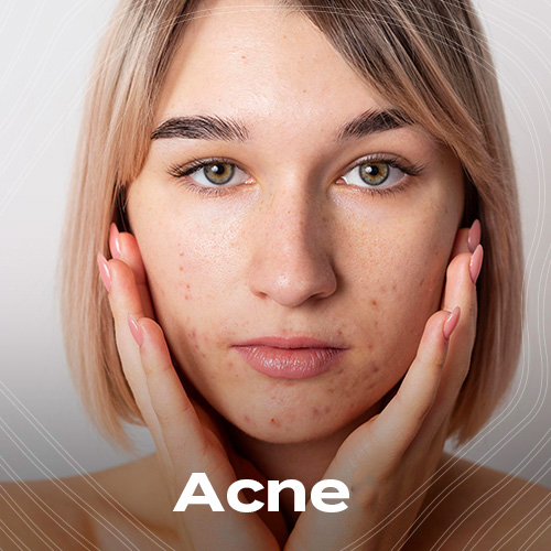 ACNE